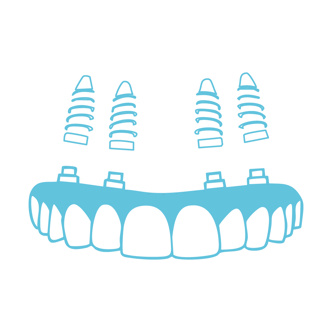 All on Four, implantes y sonrisa en 1 día